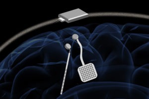Leia mais sobre o artigo Conheça o WAND, equipamento para tratar os tremores do Parkinson
